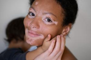 Vitiligo: Una enfermedad cutánea crónica que afecta la pigmentación de la piel
